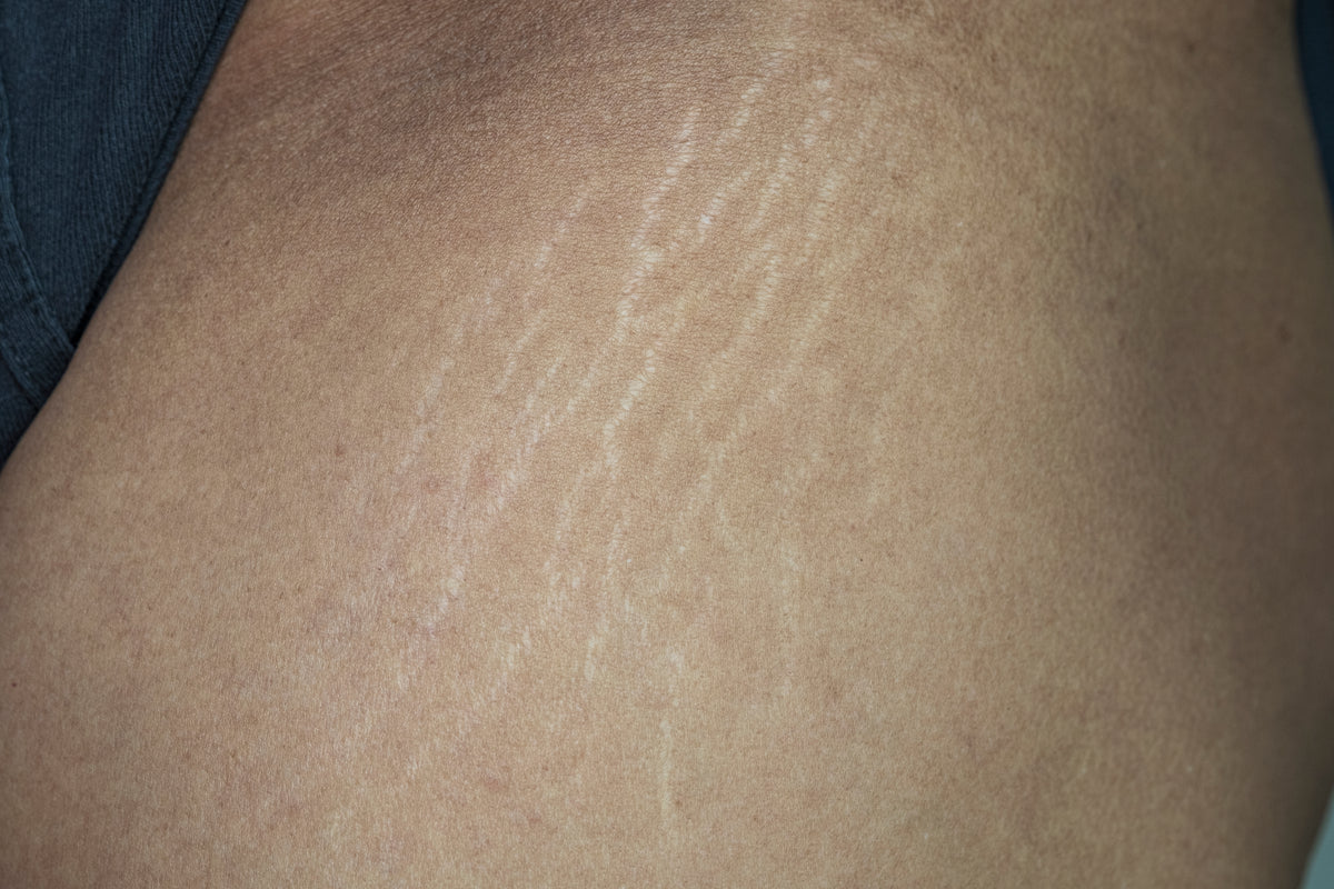 Cellulite und Dehnungsstreifen – was steckt wirklich dahinter?