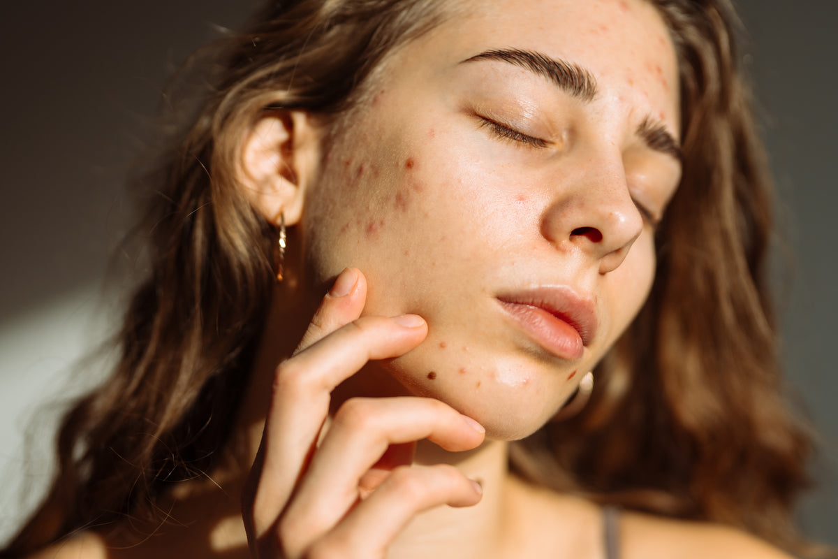 Nahaufnahme des Gesichts einer jungen Frau mit trockenen Stellen und Pickeln an der Wange